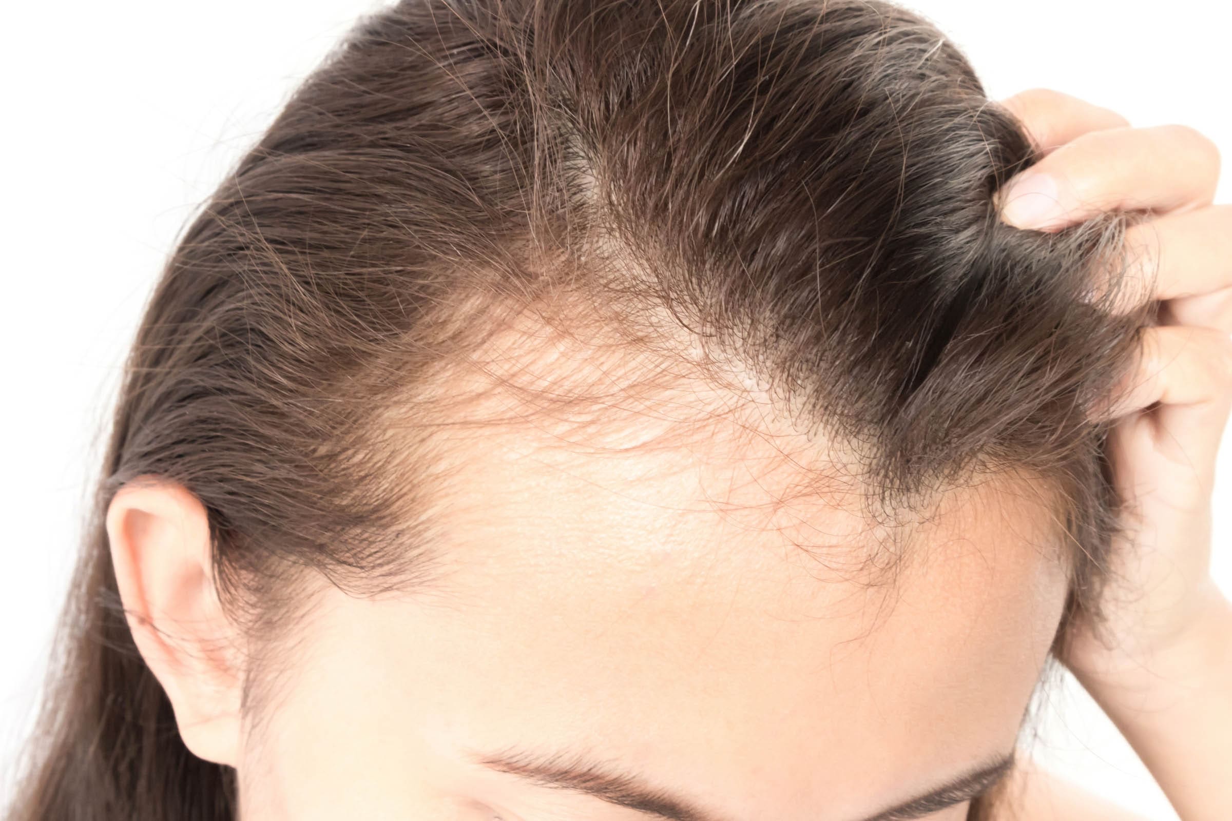 National Hair Loss Awareness Month